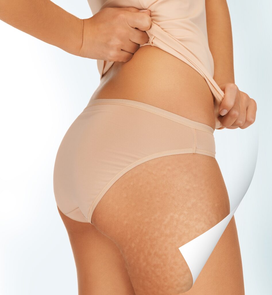 Endermologia Nowoczesna Metoda Walki Z Cellulitem