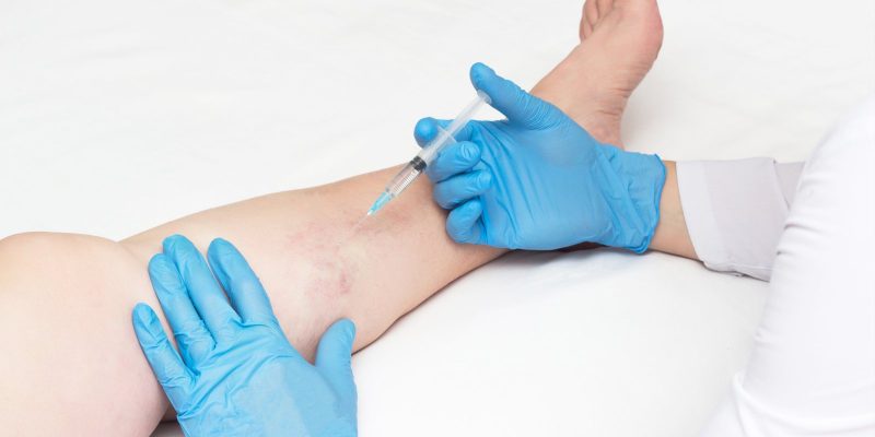Skleroterapia żył, żylaków i rozszerzonych naczyń krwionośnych
