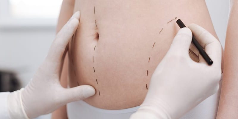 Odsysanie tkanki tłuszczowej liposukcja Kraków