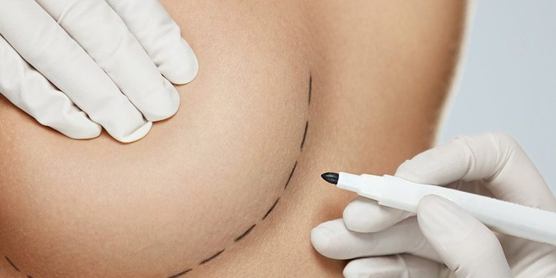 Modelowanie i powiększanie piersi, pośladków